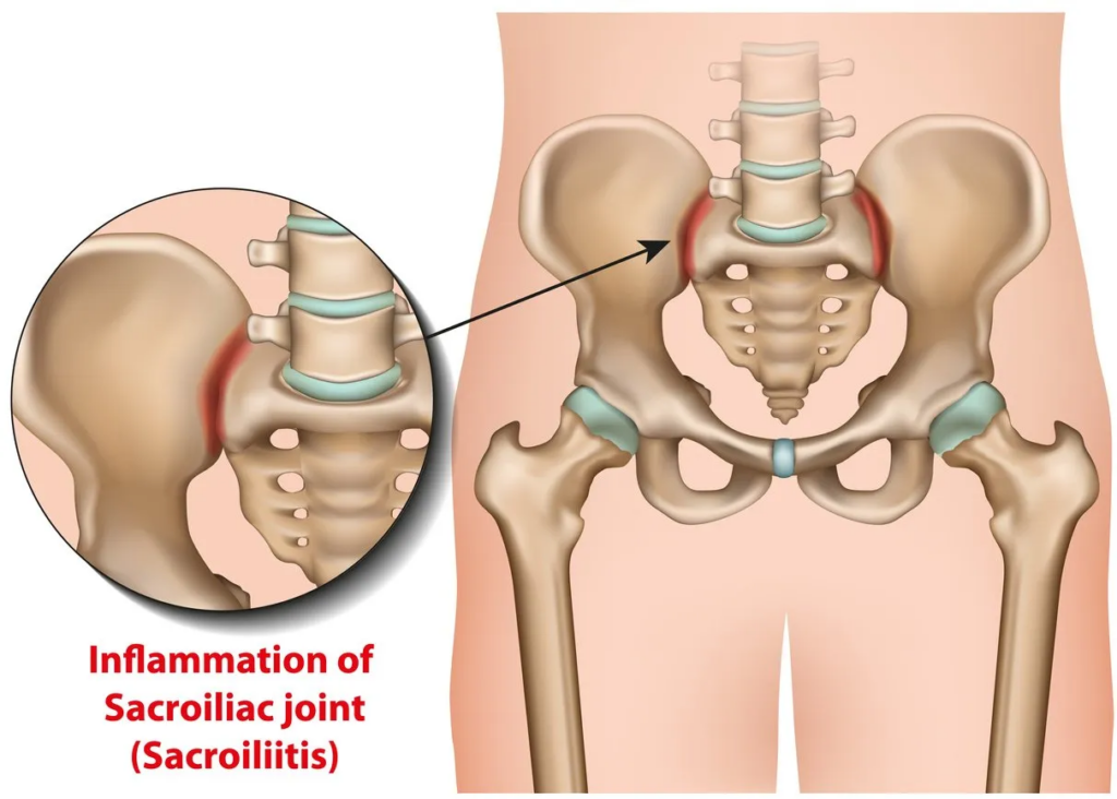 Lumbar Disc & Sciatica Pain - Dr. Todd Jackman - St. Paul Spine Surgeon