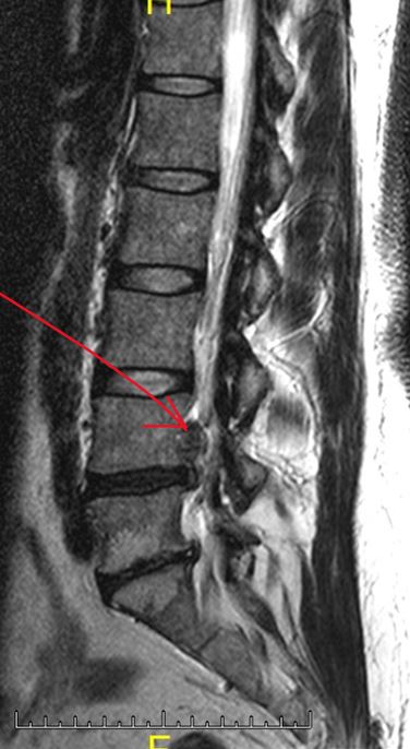 Disc Herniation, Lumbar Spine