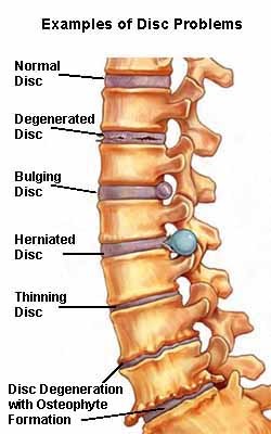 PROGRESSION OF SPINAL PATHOLOGY