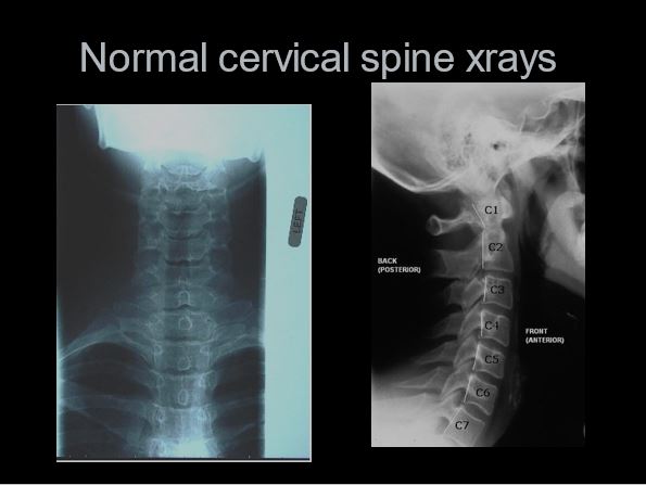 Normal cervical spine xrays
