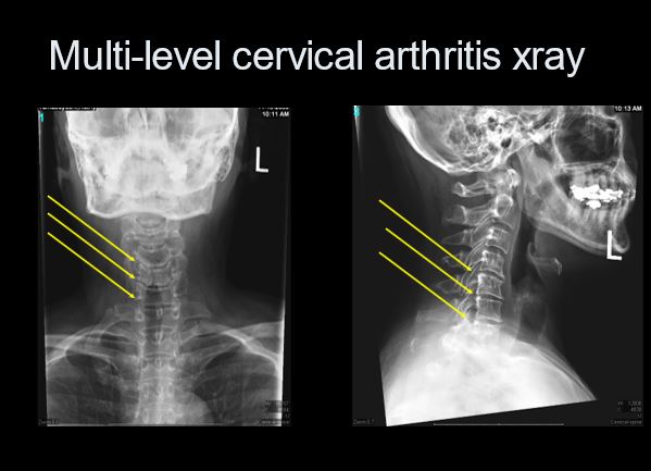 Multi-level cervical degenerative disc disease