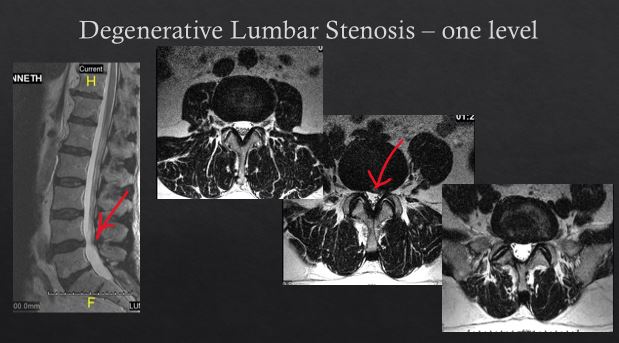 MRI DEPICTING SPINAL STENOSIS, SINGLE LEVEL