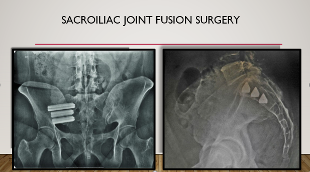 Sacroiliac Joint Fusion Surgery