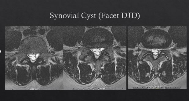 Synovial cyst arising from arthritic facet joint