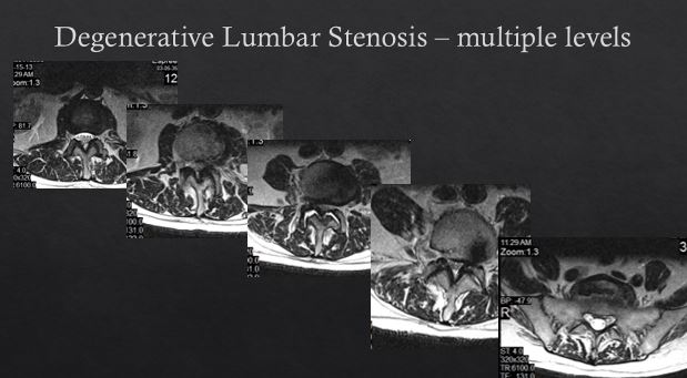 MRI DEPICTING SPINAL STENOSIS, MULTIPLE LEVELS