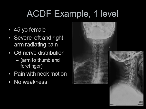 One level ACDF for single level pathology