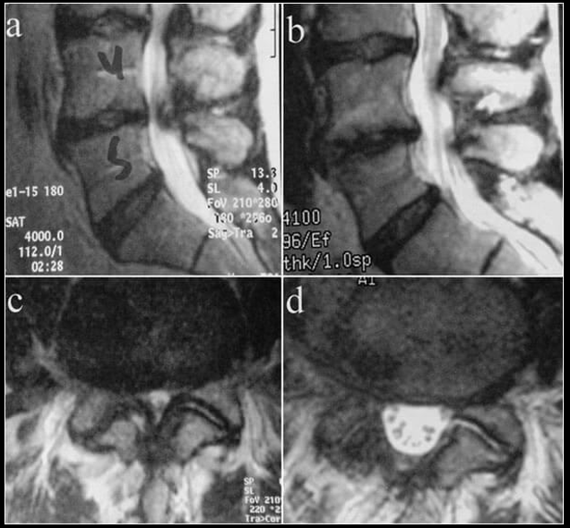L4-5 stenosis preoperative MRI (left) and postoperative MRI (right)