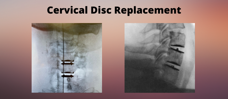 cervical disc replacement procedure