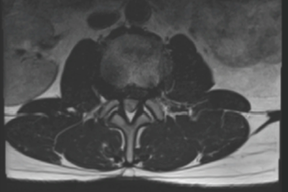 Oblique Lumbar Interbody Fusion aa